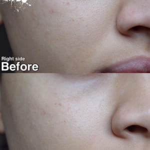 combo-la-roche-posay-kem-duong-giam-mun-40ml-gel-rua-mat-cho-da-dau-50ml