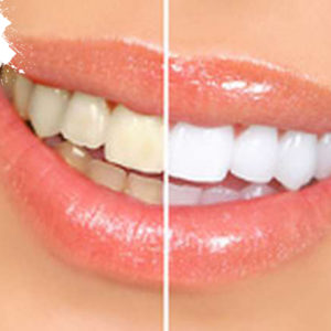 Gel Làm Trắng Răng