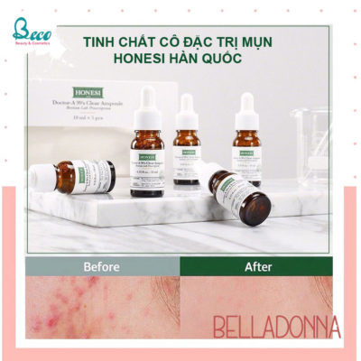 Serum trị mụn Honesi Docter A99
