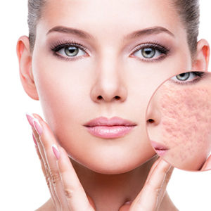 Kem Trị Sẹo Rỗ