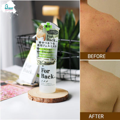 Xịt Trị Mụn Lưng