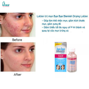 Lotion Trị Mụn Bye Bye
