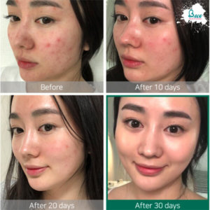 Tinh Chất Trị Mụn