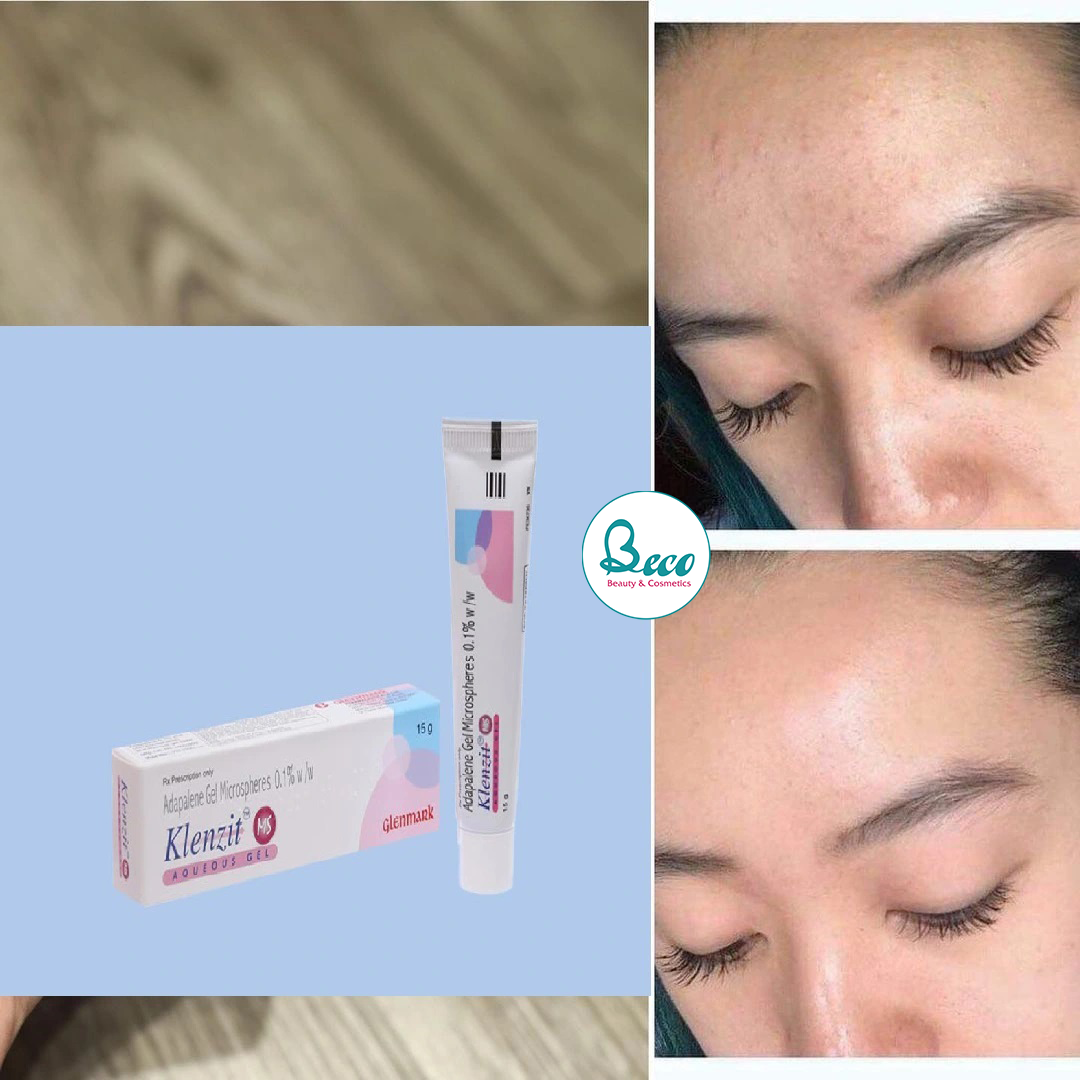 Kem trị mụn ngừa thâm Klenzit MS